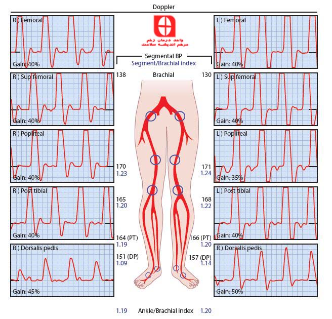 مقدار نرمال ABI TEST Arterial profile includes segmental pressures