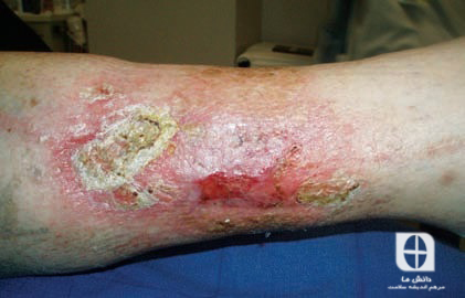 Edema due to chronic venous insufficiency