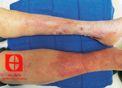 Edema due to obstruction