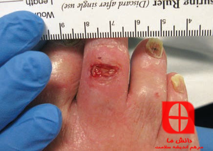 Location of wound on dorsal foot