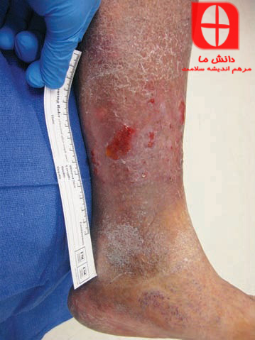 Location of wound on lower extremity