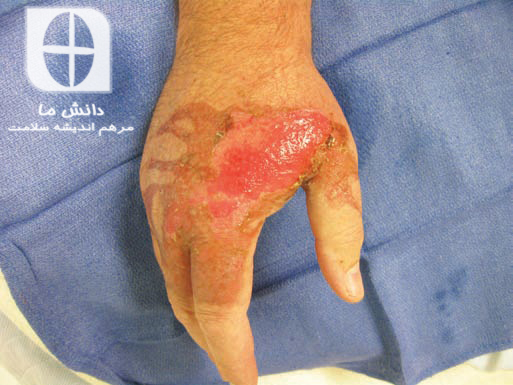 Location of wound on the hand
