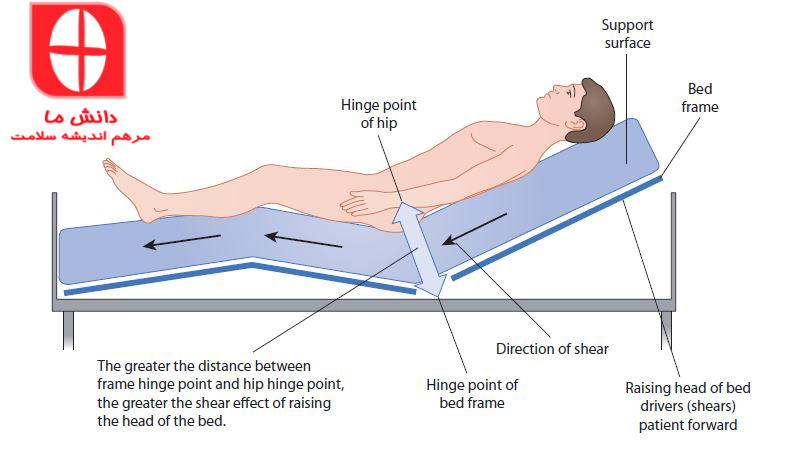 پیشگیری از زخم فشاری در تخت