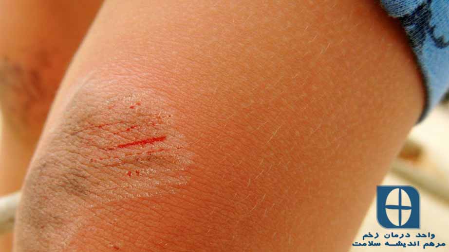 مراقبت از پوست خشک و جلوگیری از ایجاد زخم