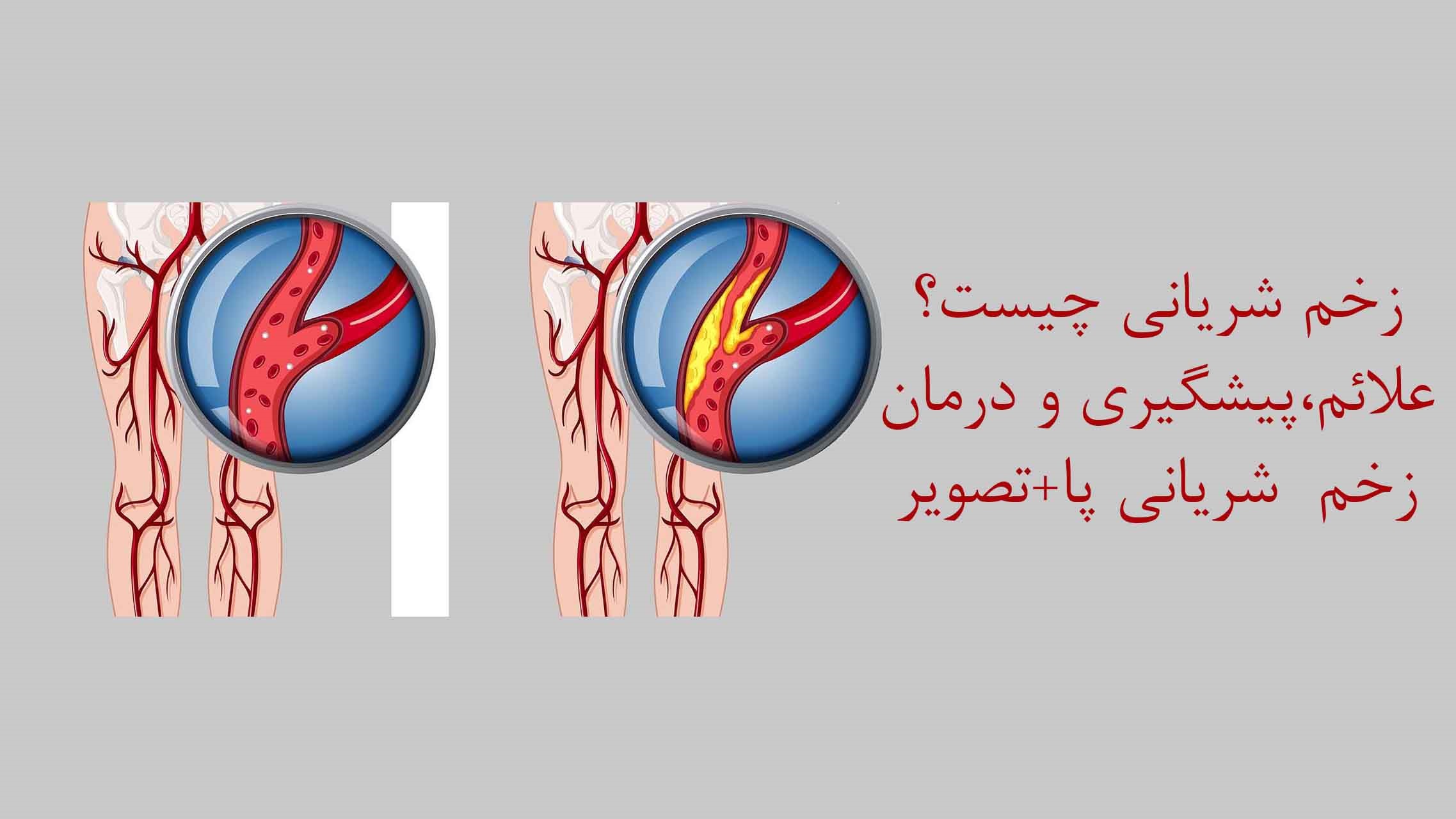 زخم شریانی