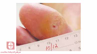تشخیص و نشانه های اولیه زخم پای دیابتی
